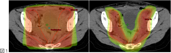 新潟県立がんセンター新潟病院のVMATの線量分布図